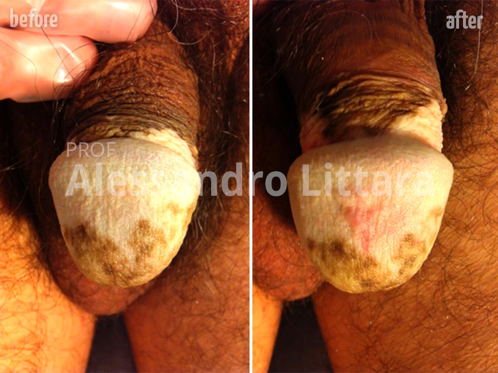 Non-Surgical Glans Enlargement, Before & After