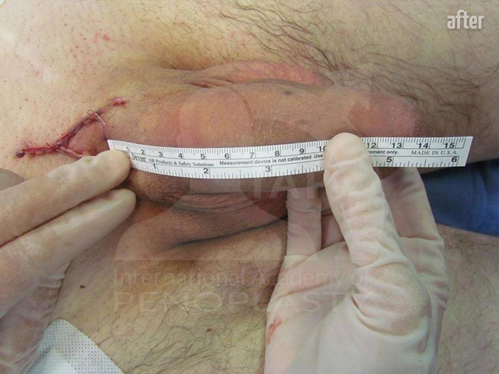 Penile Lengthening with Girth Enhancement, After
