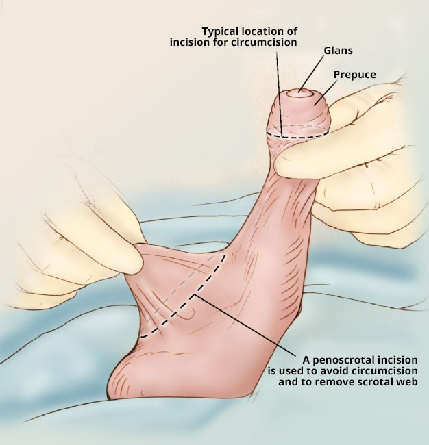 Penis Correction Surgery 115