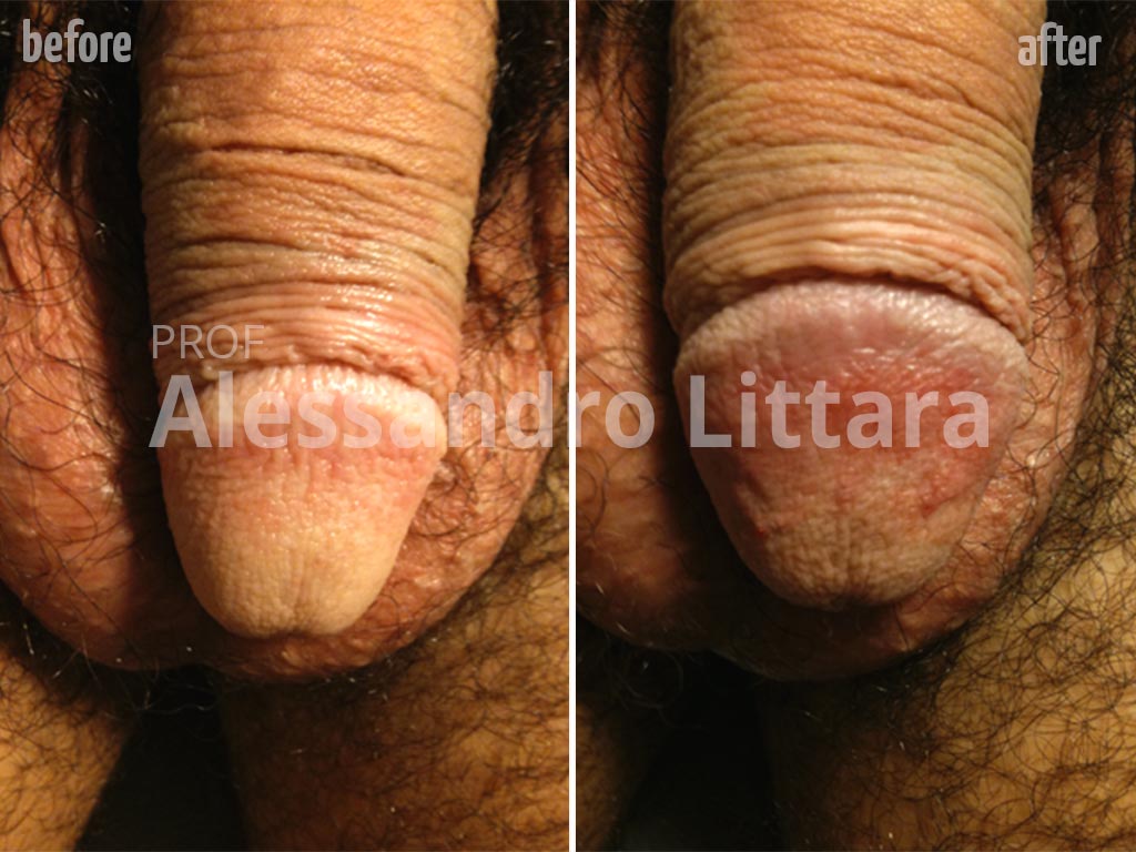 Non-Surgical Glans Enlargement, Before & After