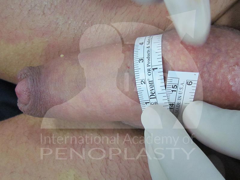 Master Course in Penoplasty, Before & After
