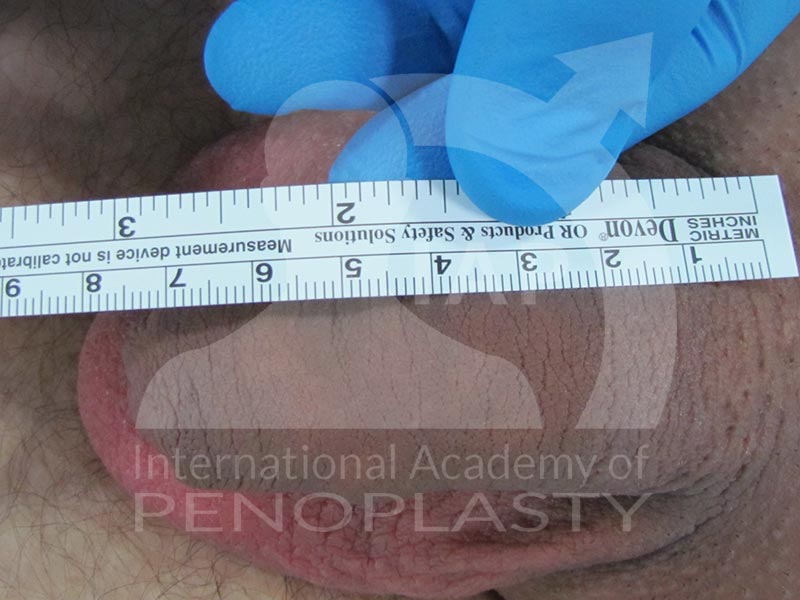 Master Course in Penoplasty, Before & After